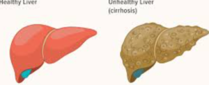 liver disease