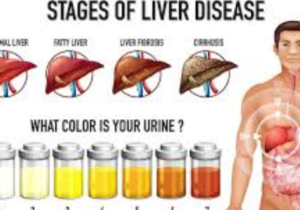 causes of liver disease